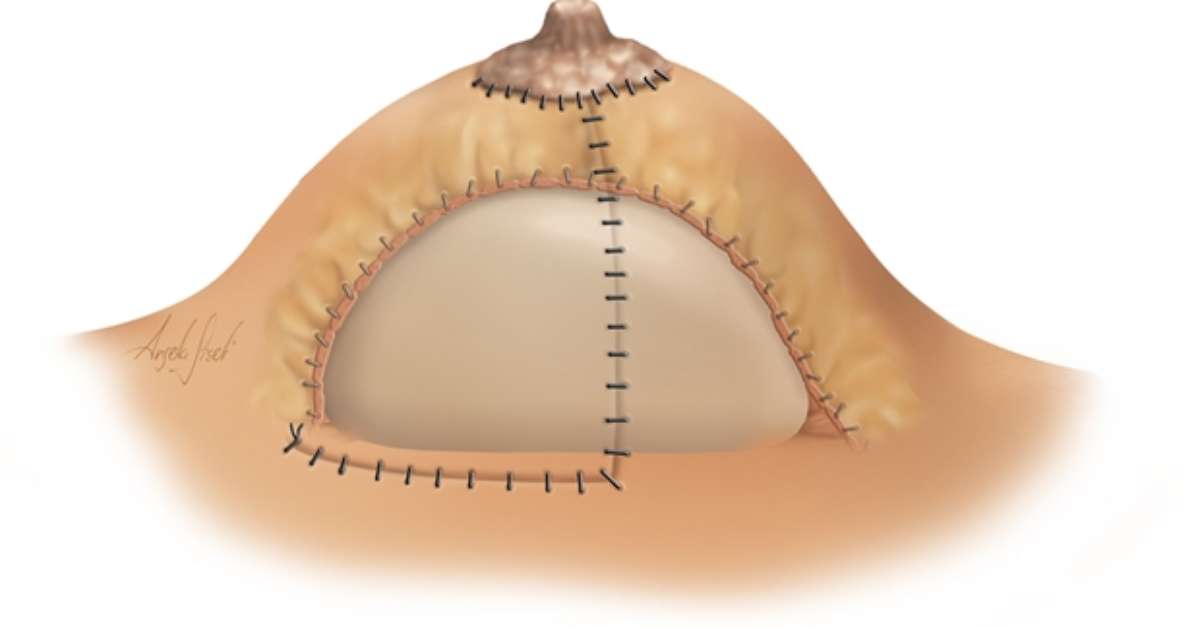 Aumenta procura por cirurgia de mama com cicatriz reduzida