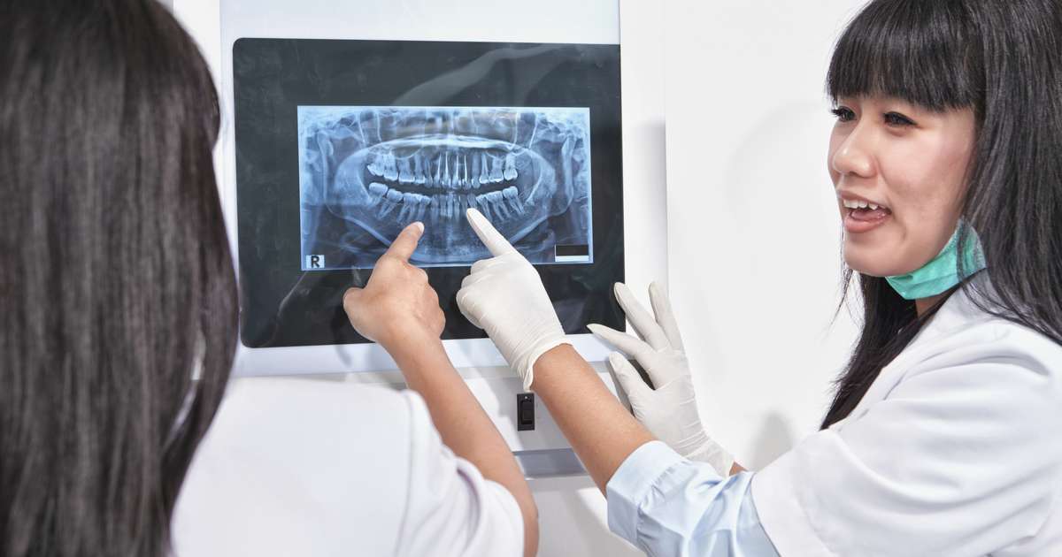 Todo Lo Que Debes Saber Sobre Los Implantes Dentales