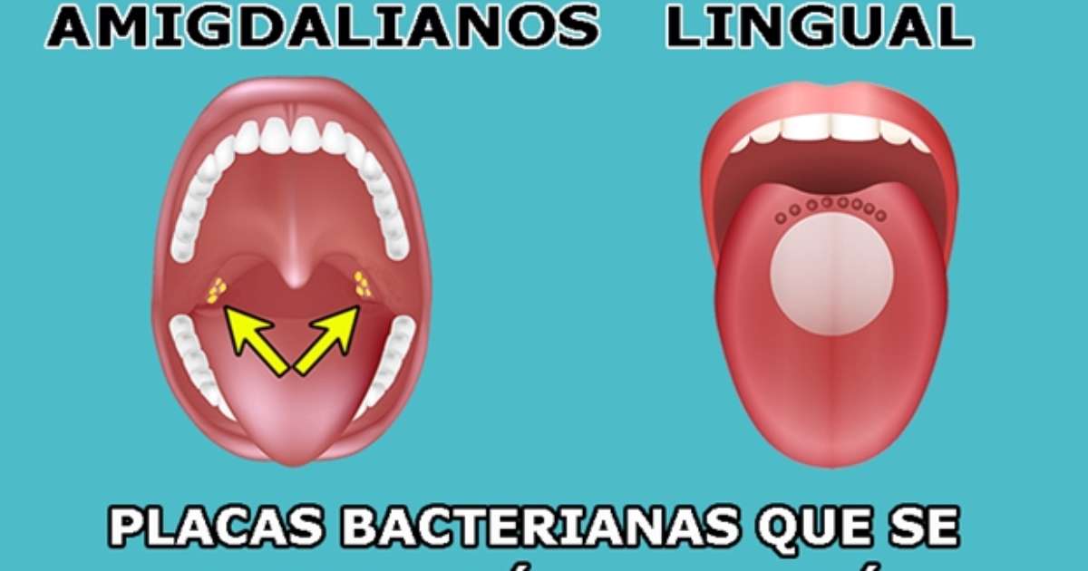 Cáseos: saiba como prevenir as desagradáveis 'pedrinhas' que se