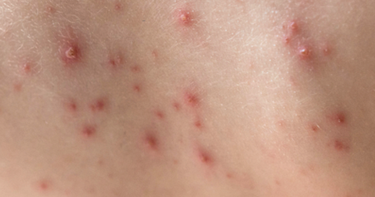 ¿Alguna vez has tenido varicela?  El virus permanece en el cuerpo para siempre y puede causar parálisis.