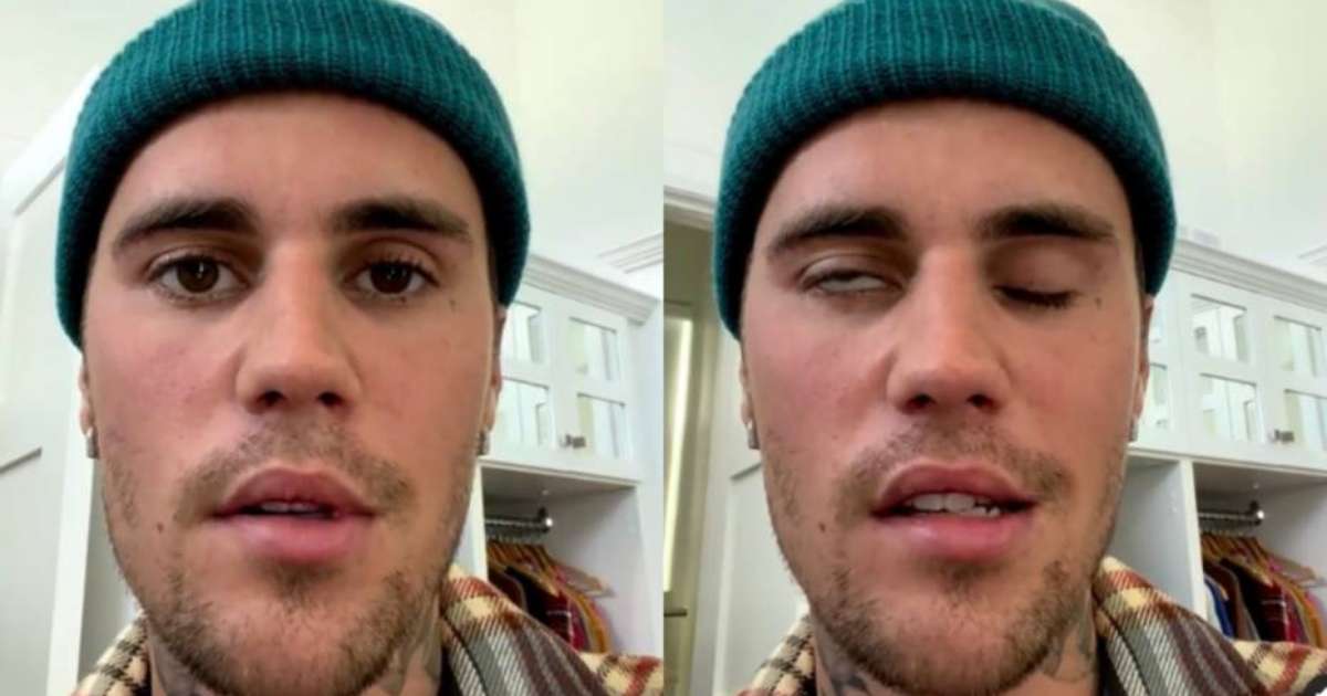 Justin Bieber aparece com metade do rosto paralisado e diz que tem ...