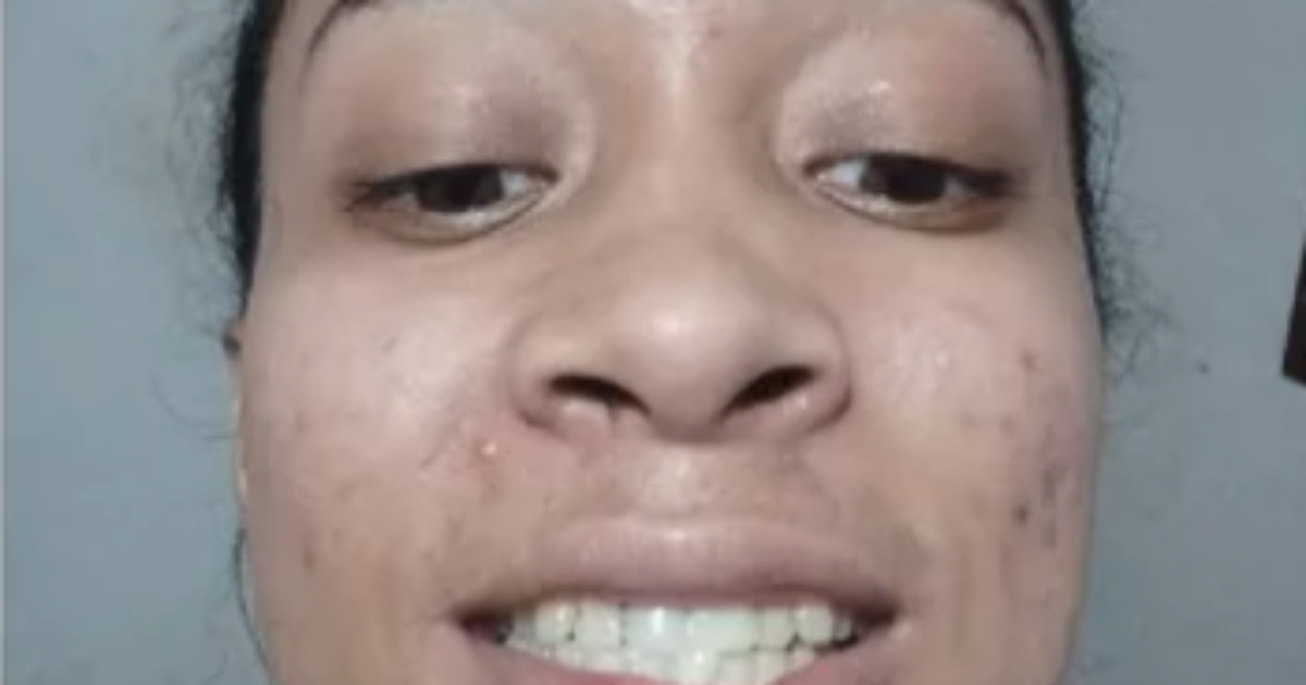 Mulher trans que teve dente quebrado por homem recupera sorriso - Terra