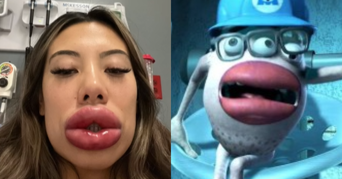 The American has an allergic reaction after lip fillers and is compared to an animated character