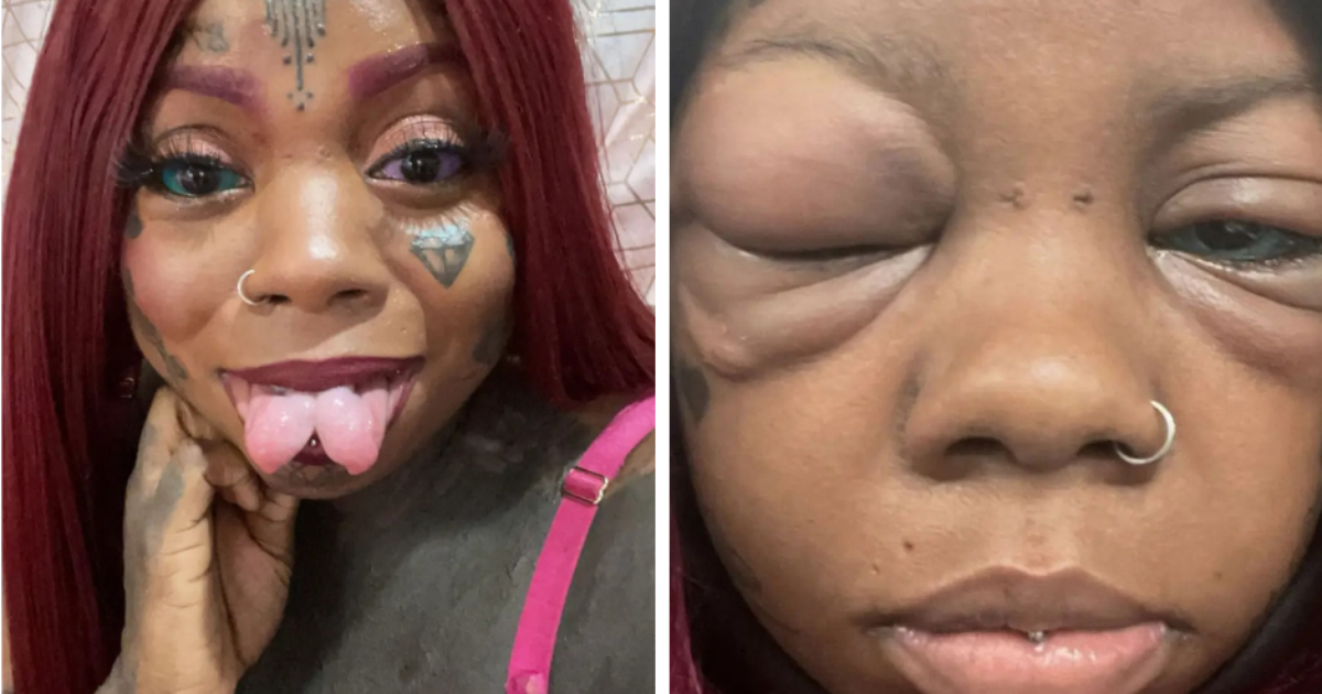 A woman is at risk of going blind after eyeball tattooing