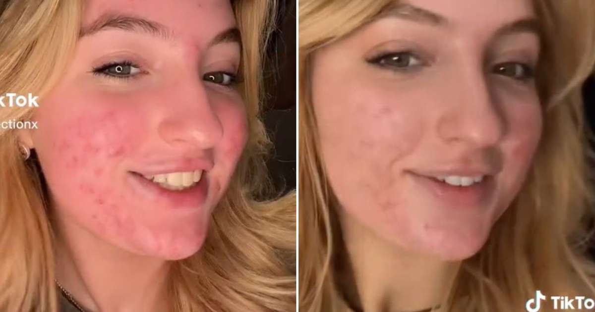 TikTok regards the acne spot as “shocking content” and bans the youngster’s account