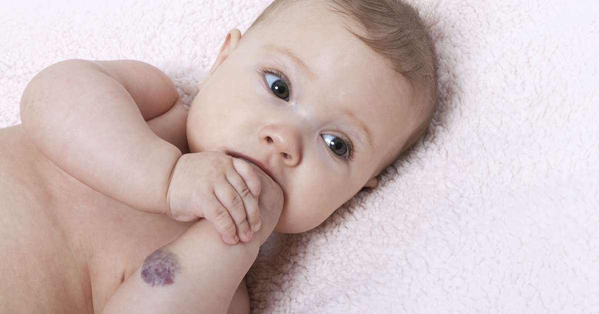 Hemangioma infantil: entenda o que é esse tumor benigno