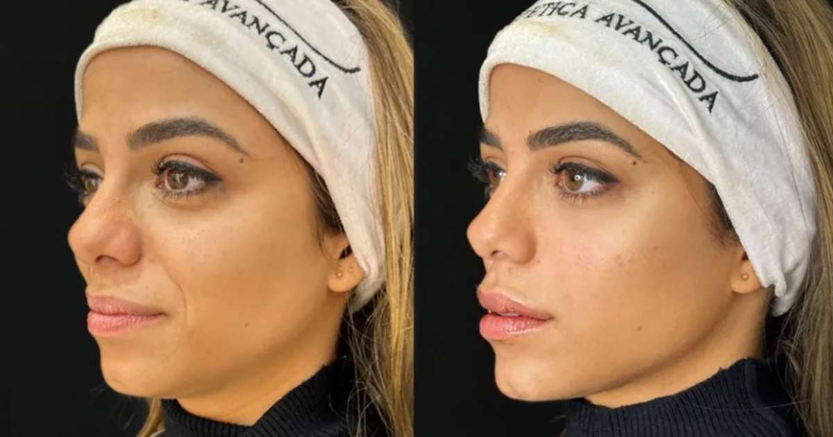 Key Alves Passa Por Harmonização Facial; Veja Antes E Depois