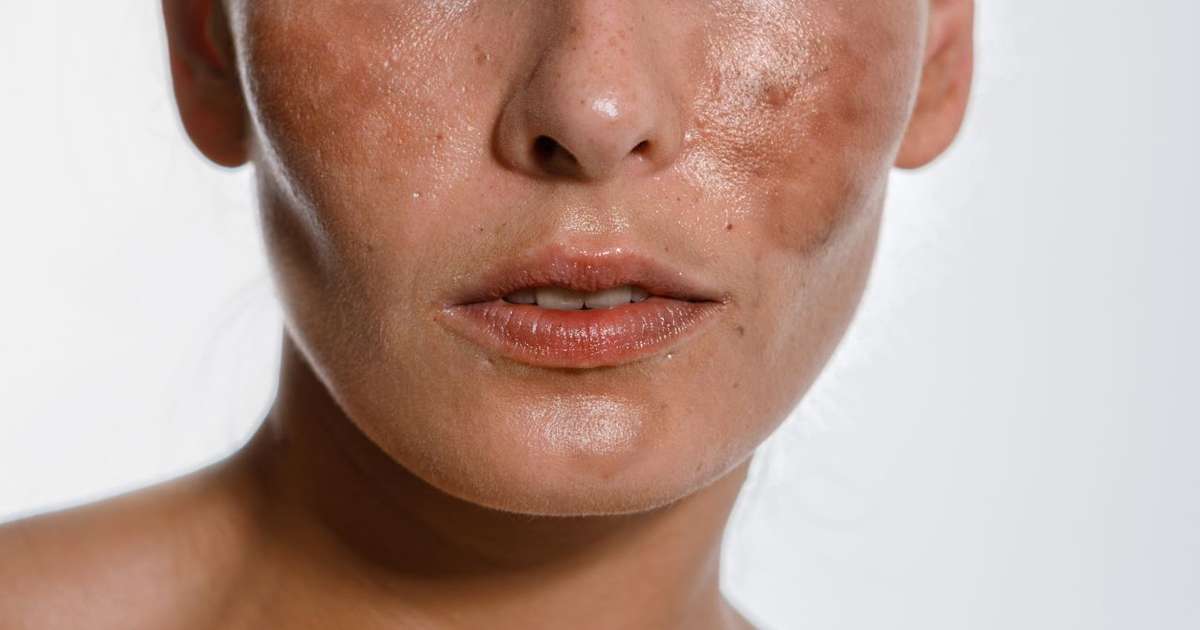 Mancha branca na pele: o que pode ser? Dermatologista explica detalhes