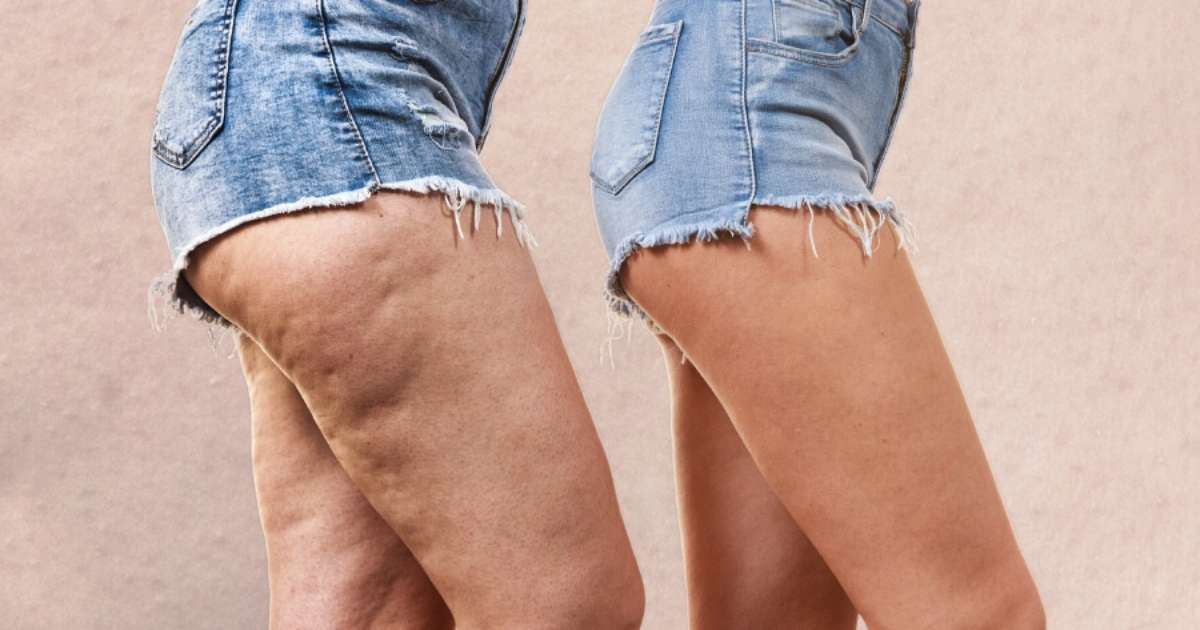 Celulite: mitos e verdades que andam dizendo por a&iacute;