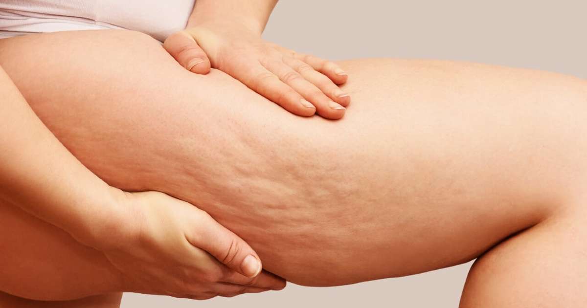 Biom&eacute;dica esclarece as principais d&uacute;vidas sobre as celulites