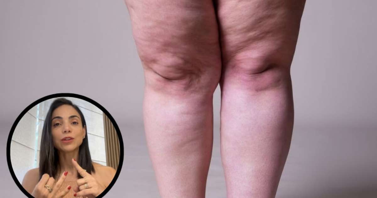 Lipedema: 7 Estratégias de Autocuidado e Apoio