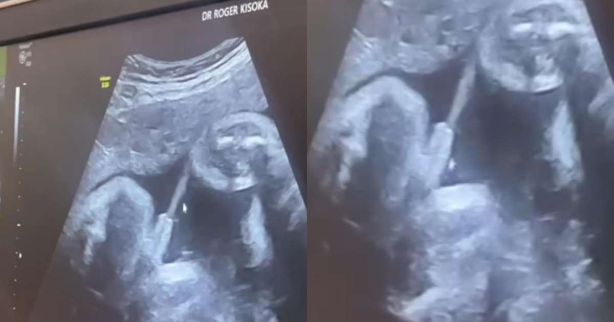 beb-faz-xixi-durante-ultrassom-e-v-deo-surpreende-a-web-obstetra-explica