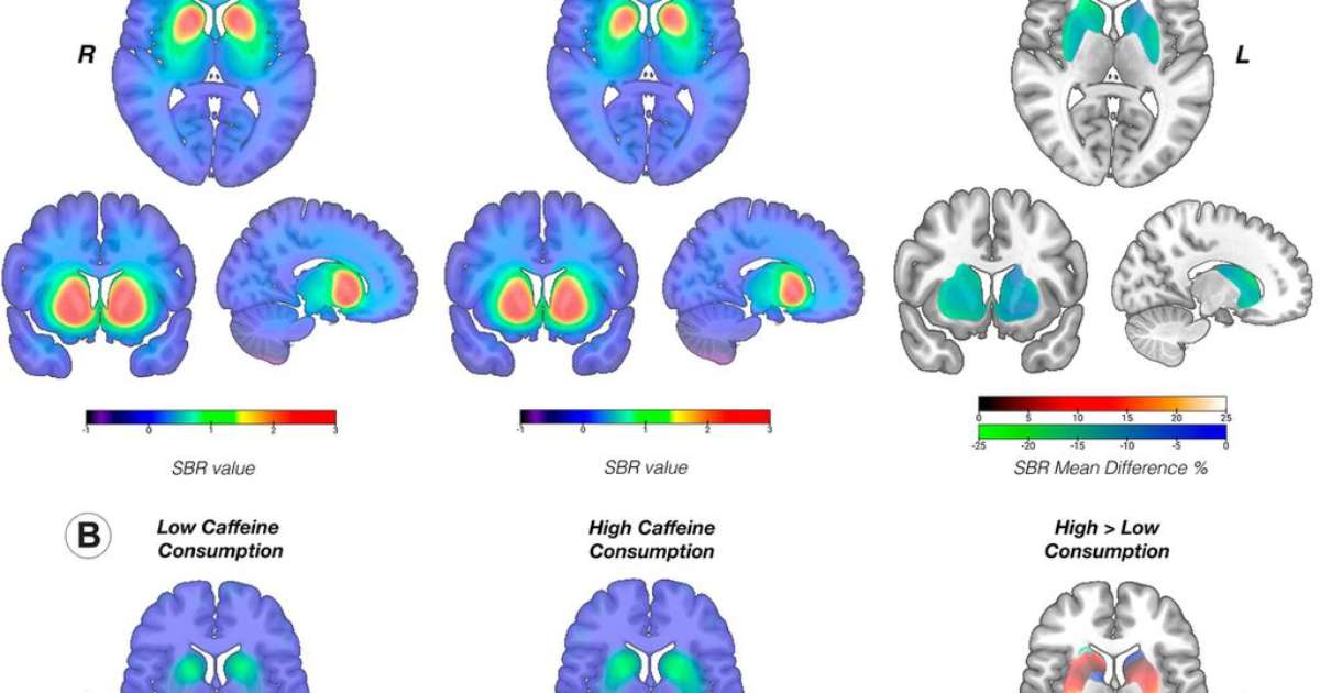 Coffee affects dopamine in the brain of people with Parkinson's disease