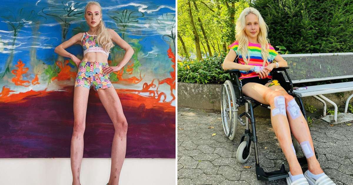 A German model shows the results of bone lengthening surgery to become 14 cm taller
