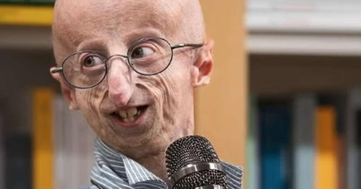 Sami Basu, the longest-living person with progeria in the world, has died