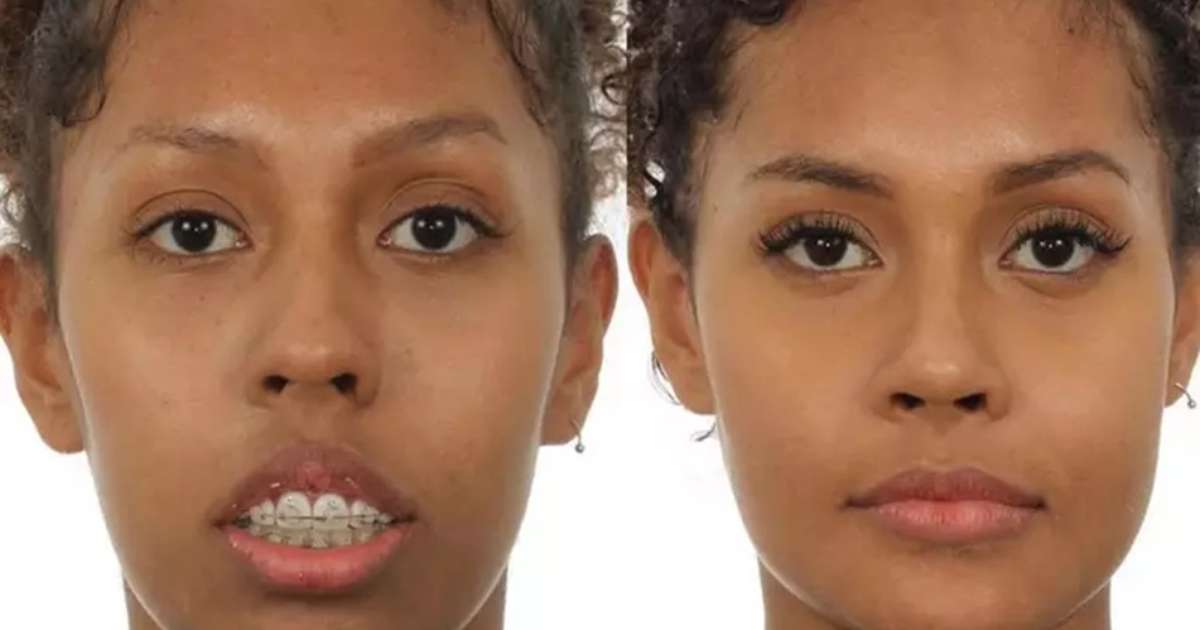 BBB25: médica compartilha antes e depois de Giovanna Jacobina, irmã de ...