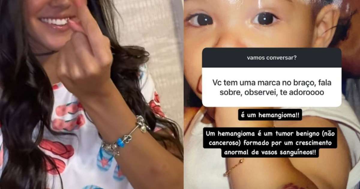 Câncer? Ex-namorada de Benício Huck, Duda Guerra revela origem de marca no braço