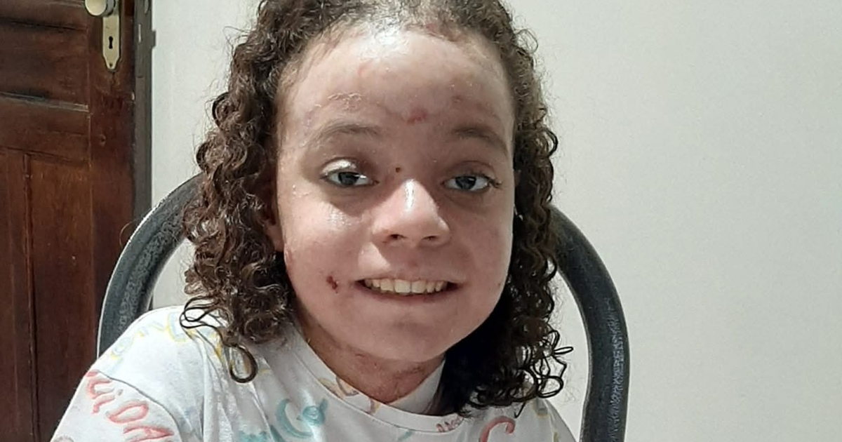 Jovem tem doença rara que causa bolhas na pele e está sem receber ...
