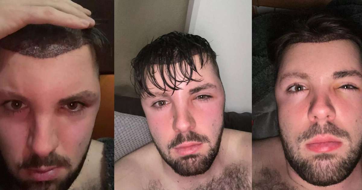 revistapazes.com - Homem fica com o rosto deformado ao ignorar proibição médica inusitada após transplante capilar