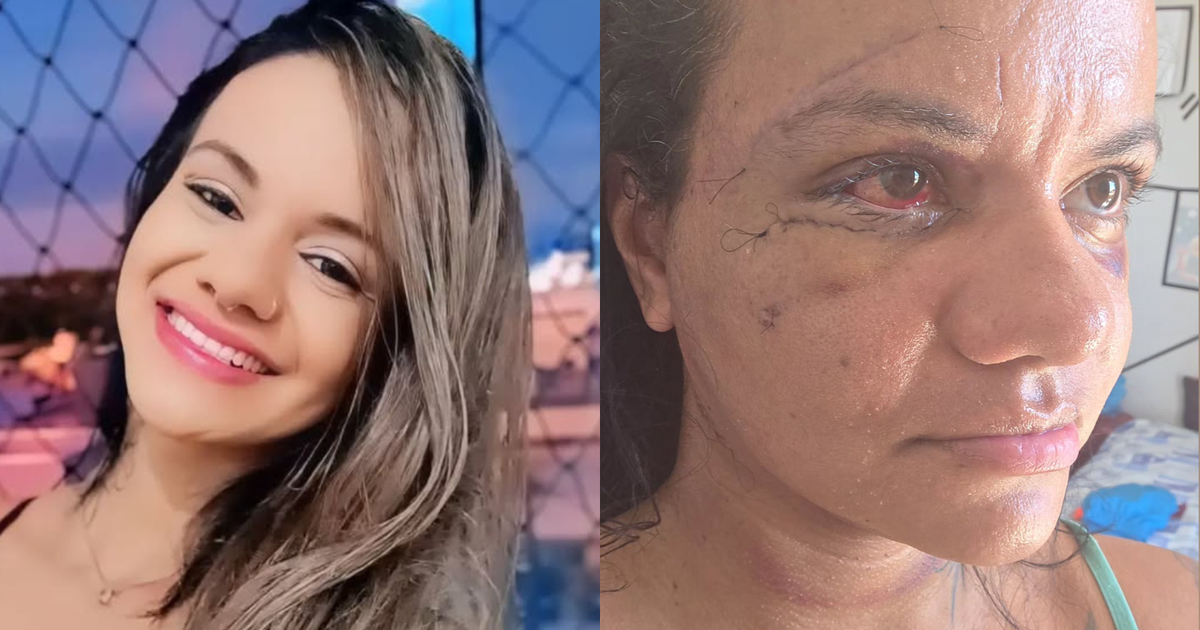Mulher agredida com 60 socos mostra rosto uma semana após cirurgia
