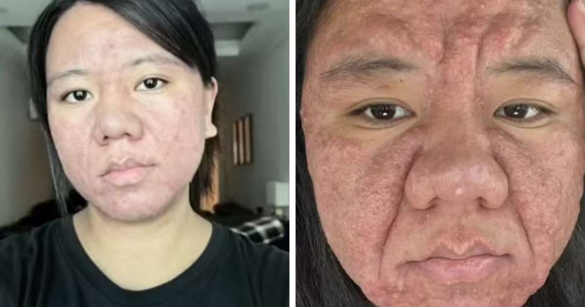 Gravidez e Acne: O Que Fazer com a Acne Gravídica?