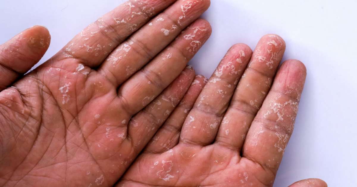 Coceira e bolhas nas mãos: saiba identificar se é disidrose