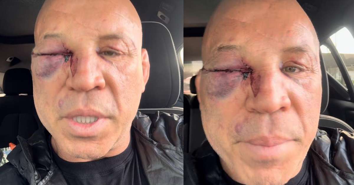 'Muita tontura e uma dor de cabeça que não passa' diz Wanderlei Silva após luta com Popó