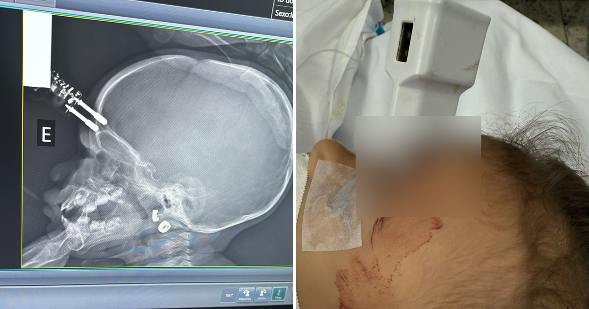 Criança Cai Da Cama E Fica Com Carregador Cravado Na Testa Em Mg Veja