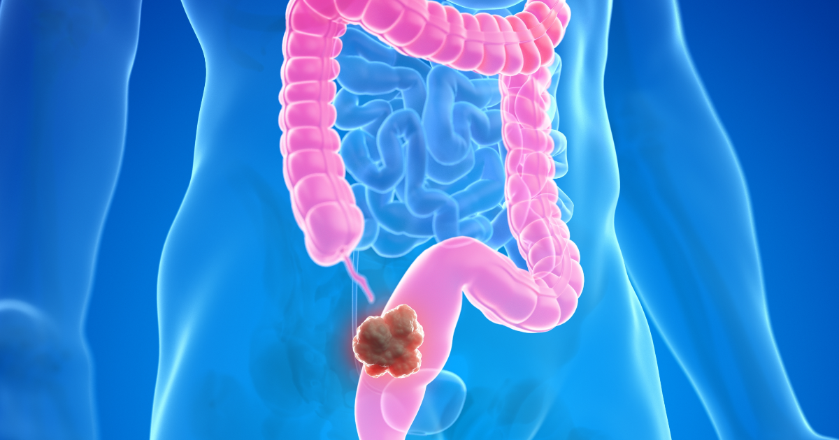 O rastreamento do câncer colorretal mudou no Brasil: SUS adotou um novo teste caseiro que antecipa o diagnóstico do câncer de intestino com tecnologia super sensível ao sangue invisível