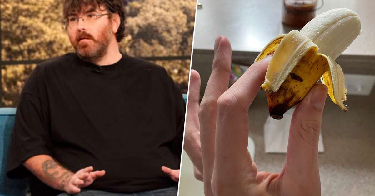 O homem com o menor pênis do mundo encontrou uma solução online: "Nunca pensei que alguém se importaria"