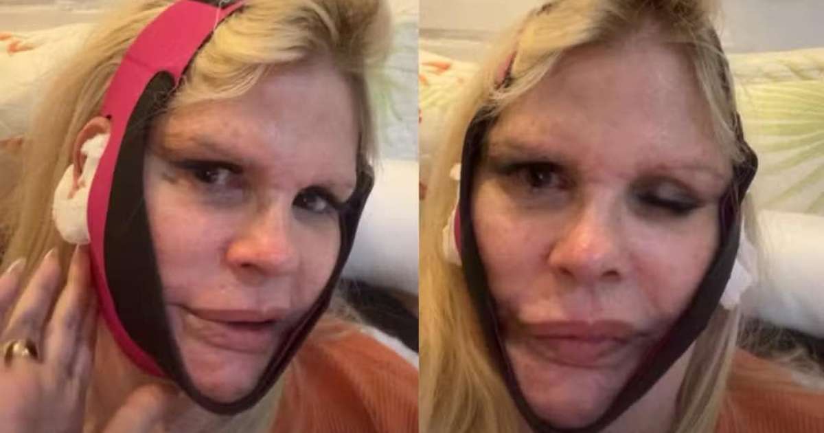 Monique Evans mostra recuperação após cirurgia no rosto e faz piada: 'Meu medo é o banco não me reconhecer'