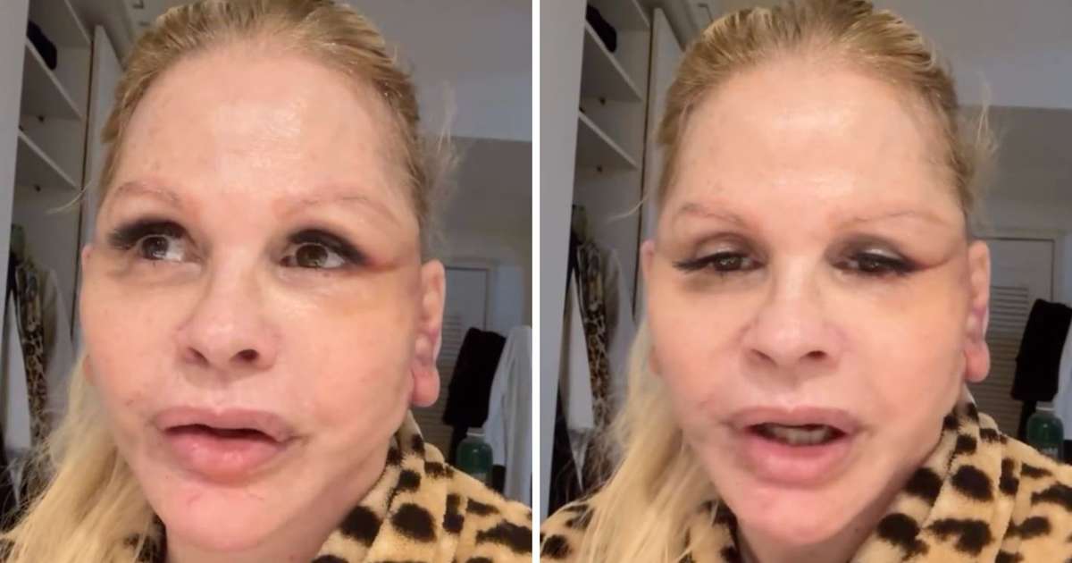 Monique Evans revela problema com reconhecimento facial de banco após cirurgia no rosto