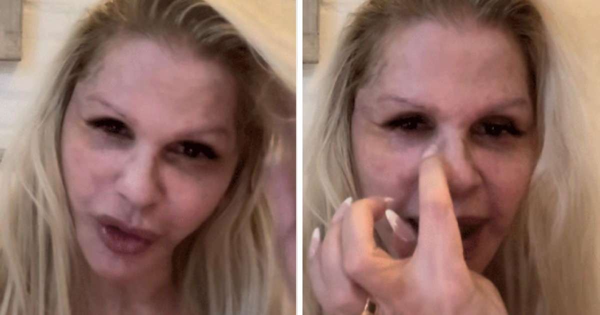 Monique Evans mostra rosto uma semana após ser 'atropelada por caminhão'
