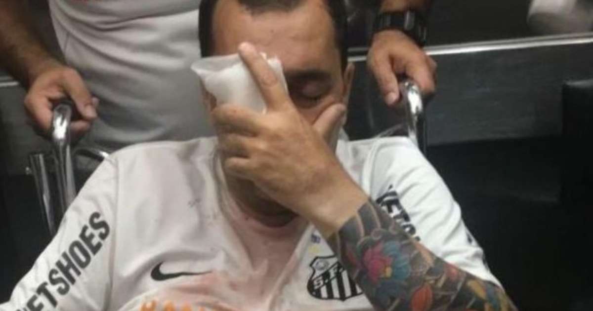 Santos e Estado de SP são condenados a indenizar torcedor que perdeu olho