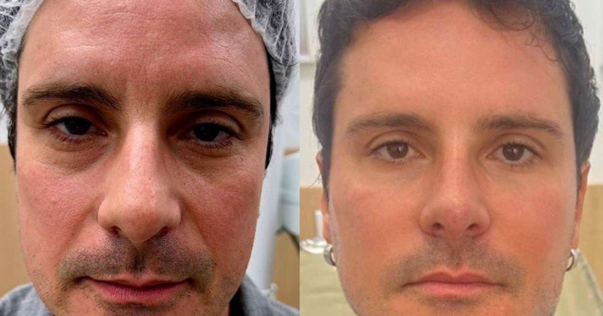 Ex-galã de 'Malhação', Sérgio Abreu surge com novo visual após harmonização facial