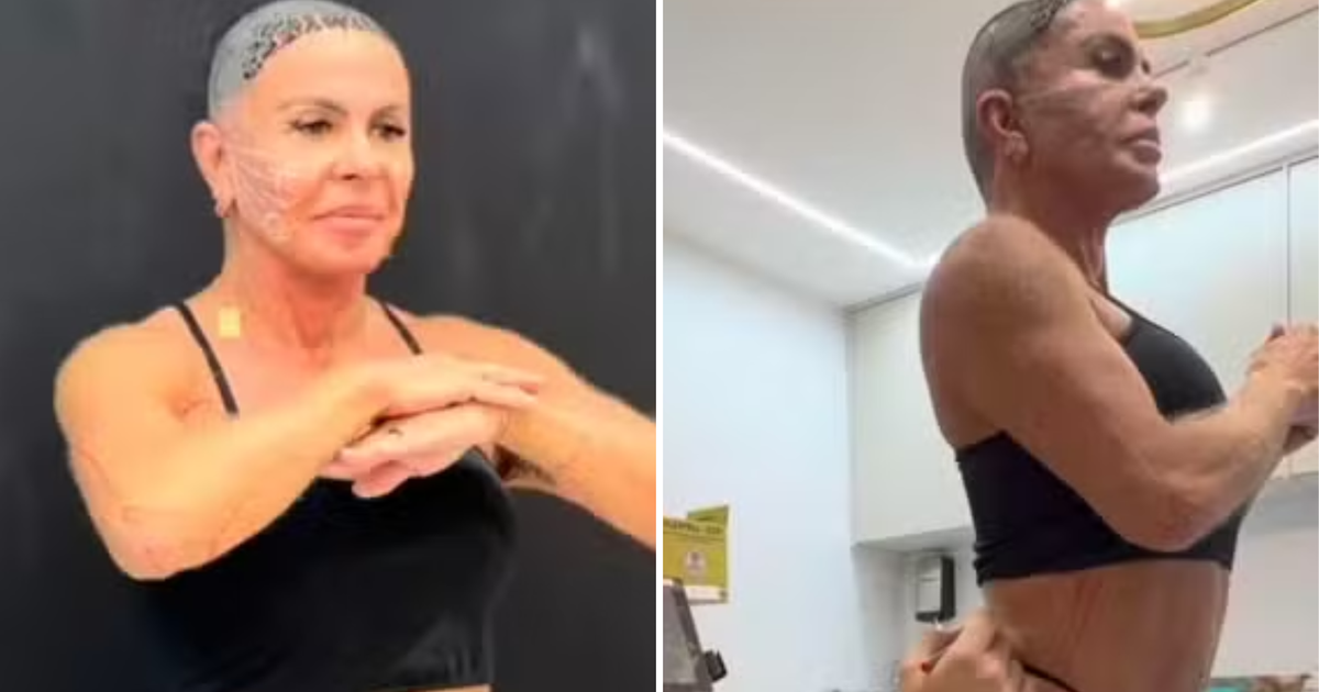 Gretchen faz procedimentos no rosto e no corpo após transplante capilar: 'Resultado incrível'