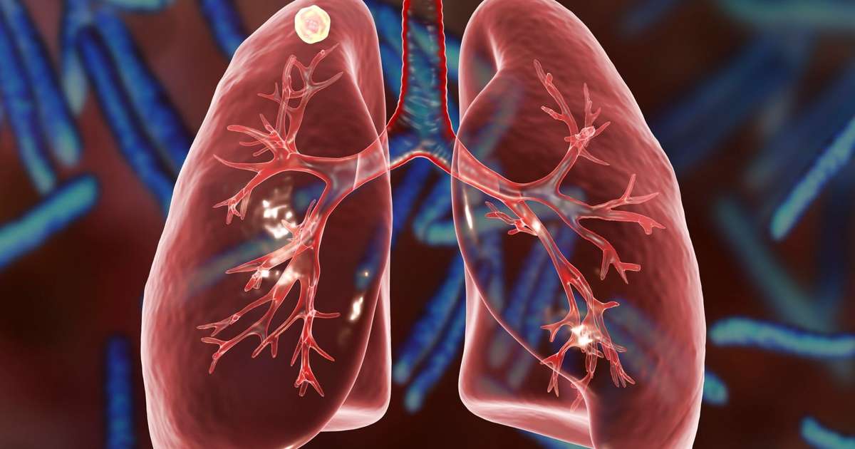 Fibrose cística: entenda a doença, os sinais e por que a conscientização é tão importante