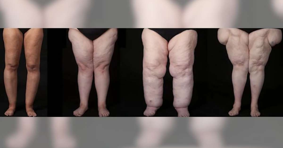 Afinal, o que é lipedema? Consenso internacional define diagnóstico e tratamentos