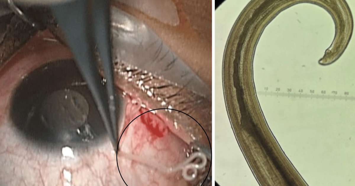 Grávida de 28 anos vê verme vivo se mexendo sob o olho; parasita poderia estar no organismo havia pelo menos 4 anos