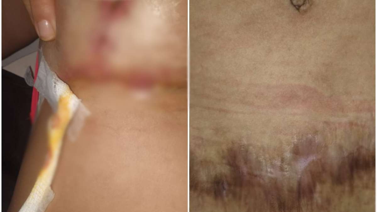 Decote free': cirurgia plástica apresenta cicatriz reduzida