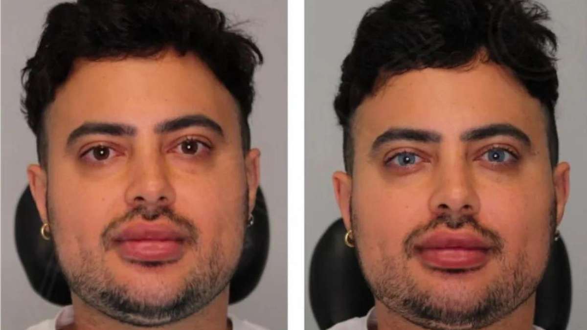 A man undergoes an operation to permanently change his eye color