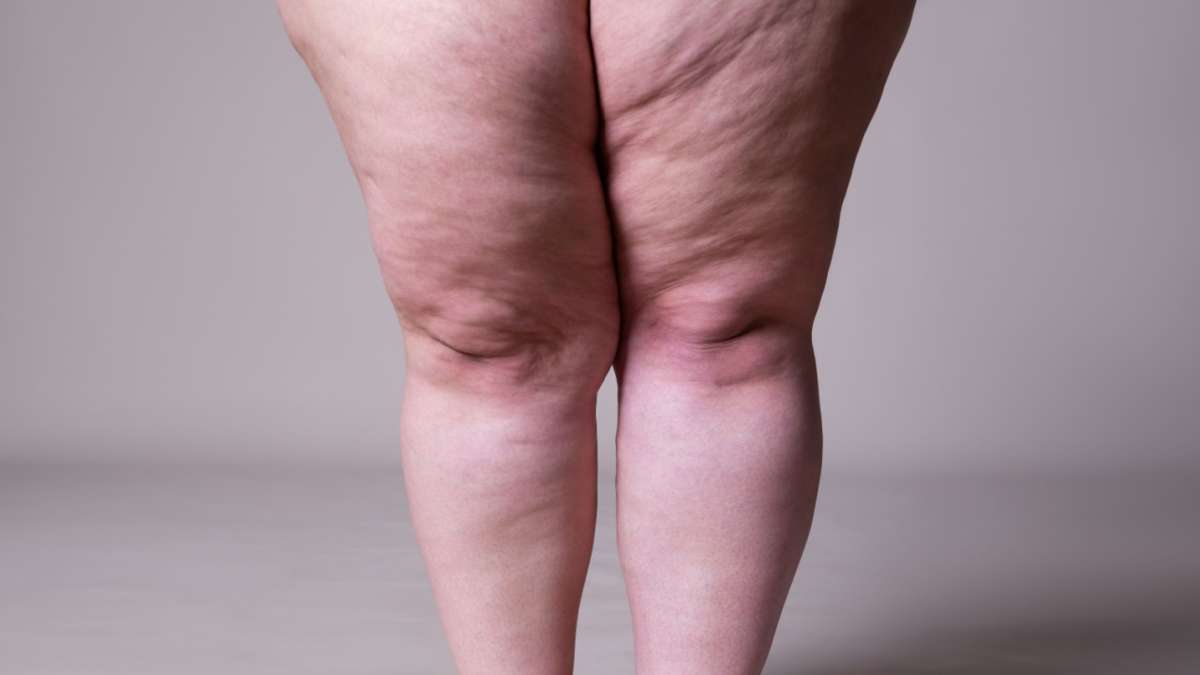 Doença causa peso nas pernas e é confundida com obesidade - Dani-se