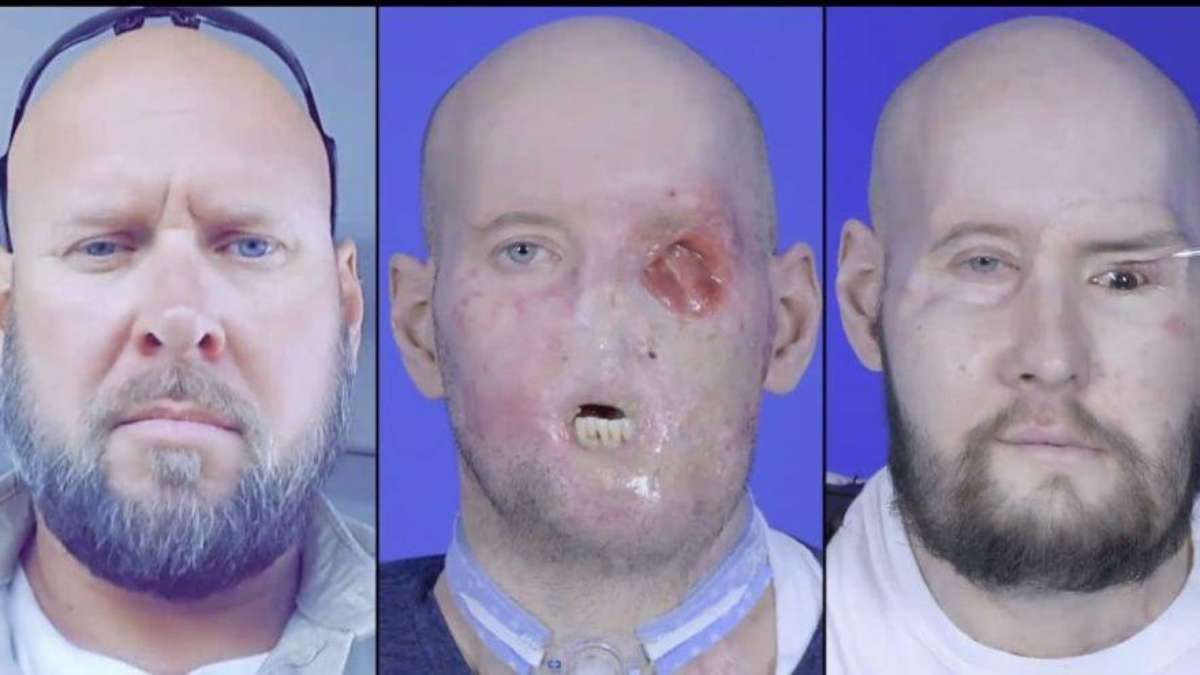 El éxito del primer trasplante completo de cara y ojos en Norteamérica