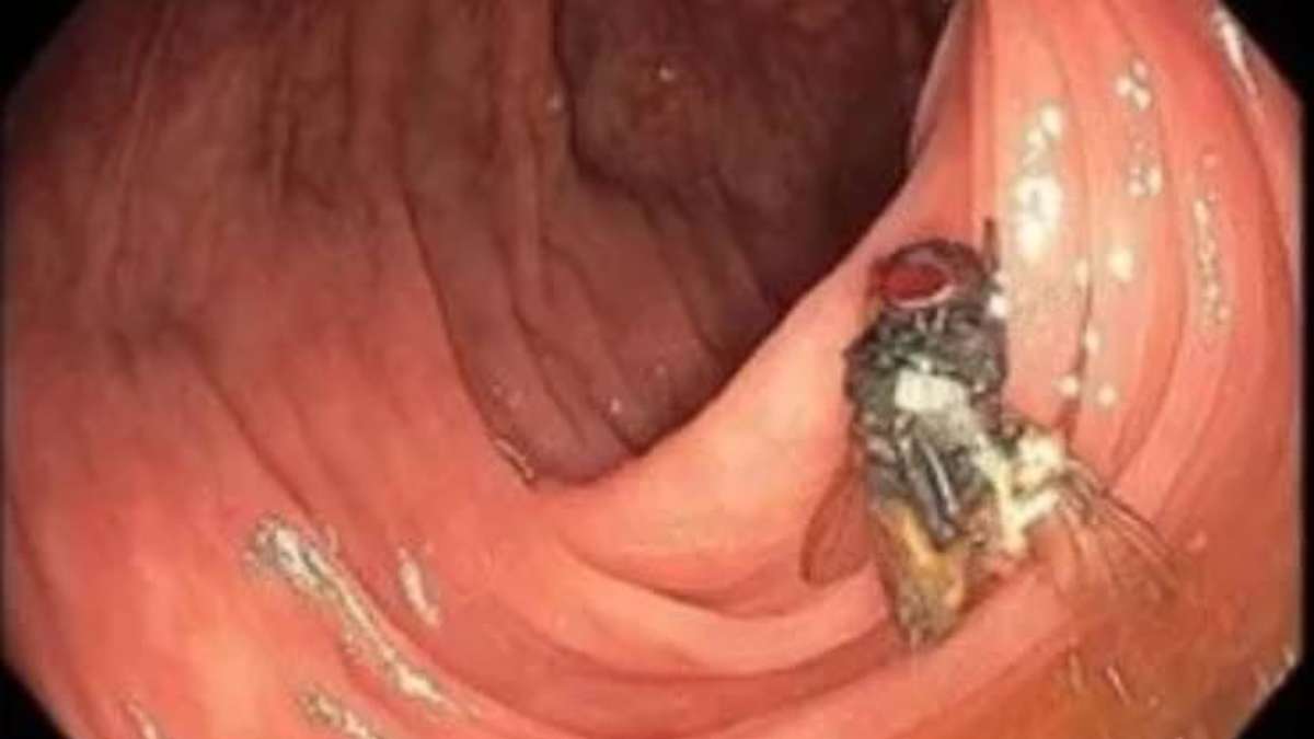 Los médicos encuentran una mosca viva dentro de los intestinos del paciente durante el examen.