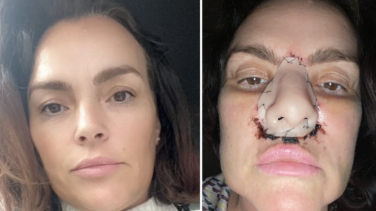 A woman loses her nose after discovering cancer and undergoing two surgeries