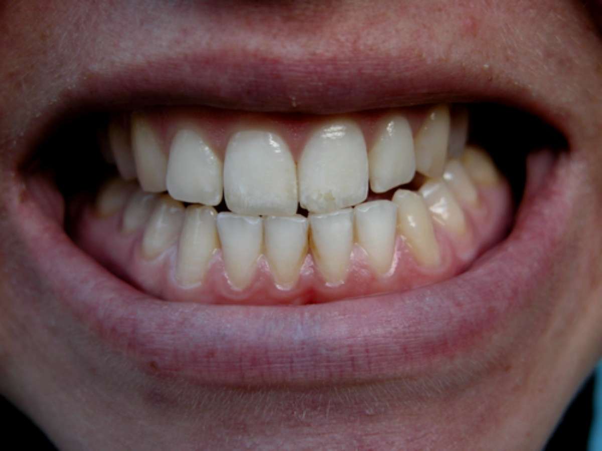 Нормальные передние зубы
