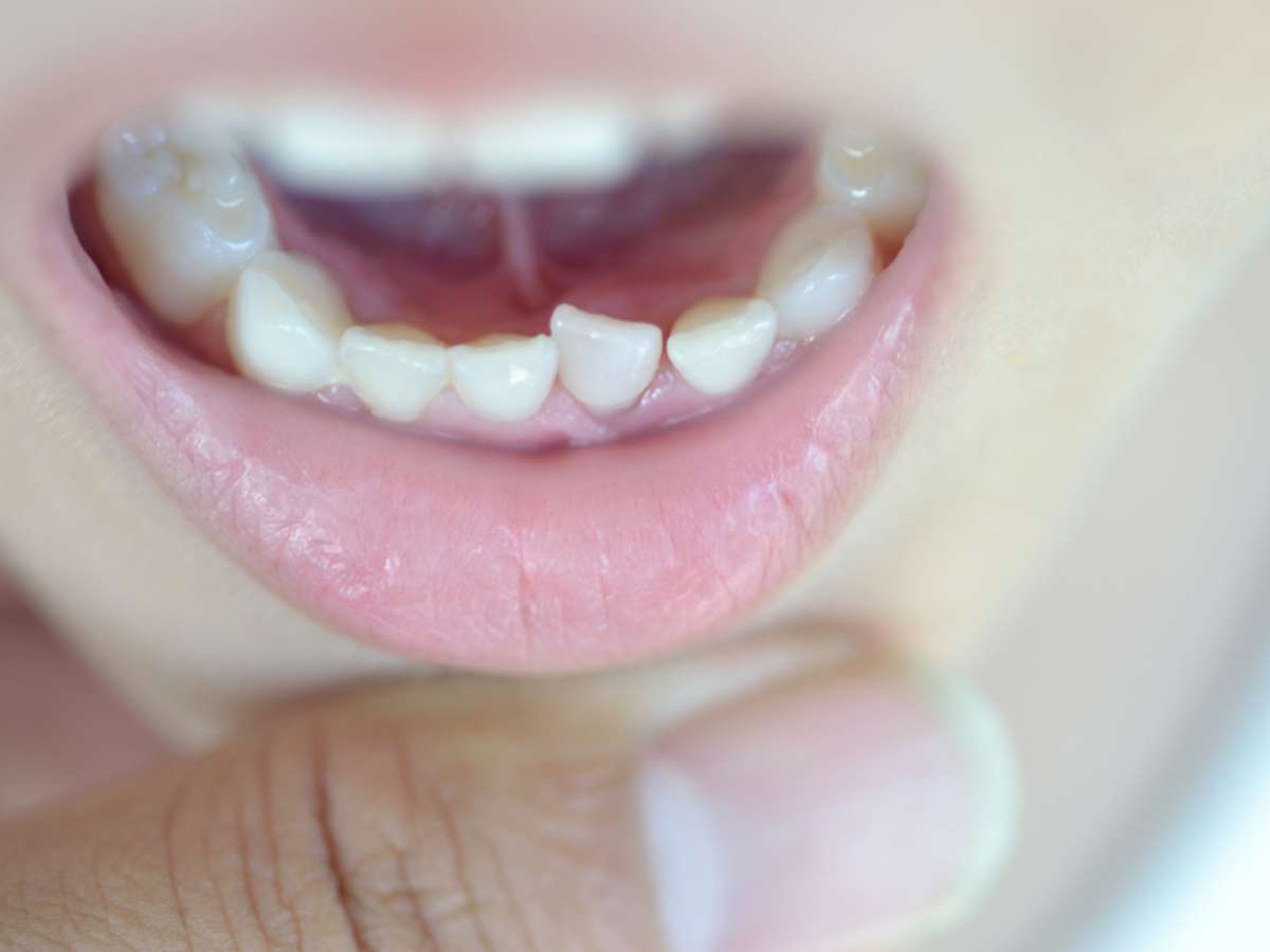 Пигментация молочных зубов