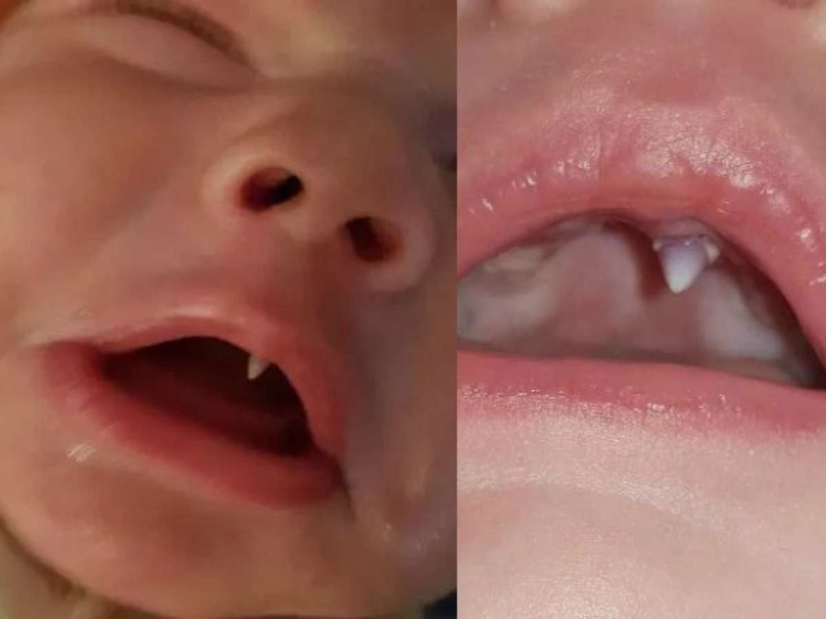 Dentes de vampiro: moda entre adolescentes no TikTok causa danos à