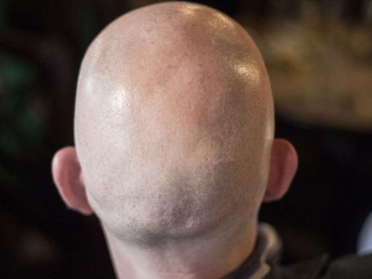 British court ruling a man as ‘bald’ is considered sexual harassment;  understand