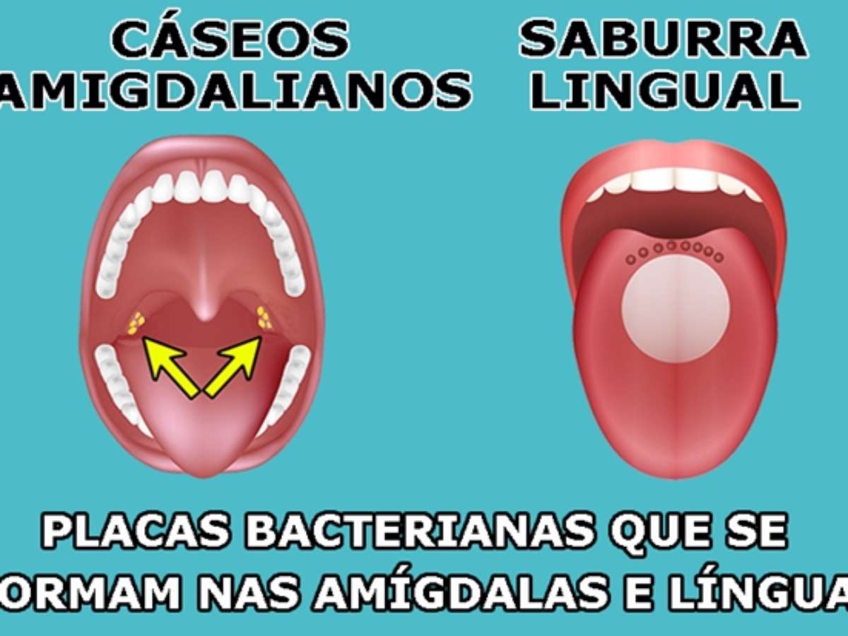 Bolinhas brancas na garganta? Entenda o que é a amígdala caseosa